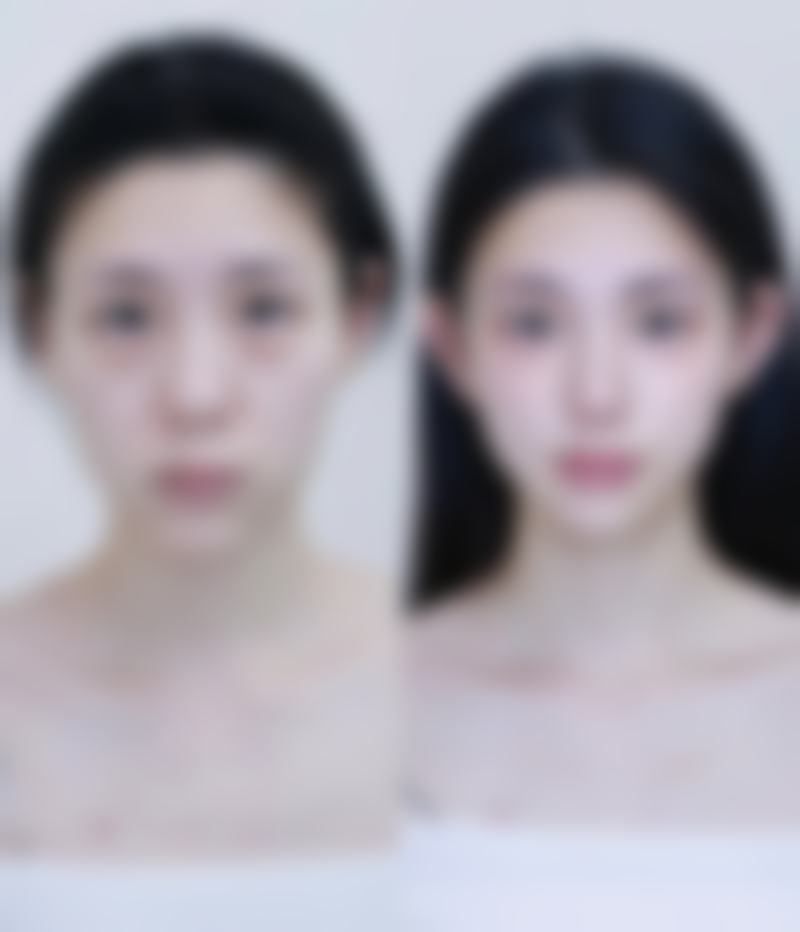 四、治疗30多年火烧伤疤痕的注意事项