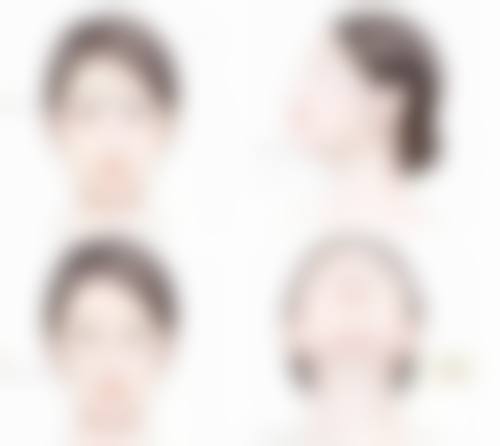 二、开双眼皮之平行形眼型