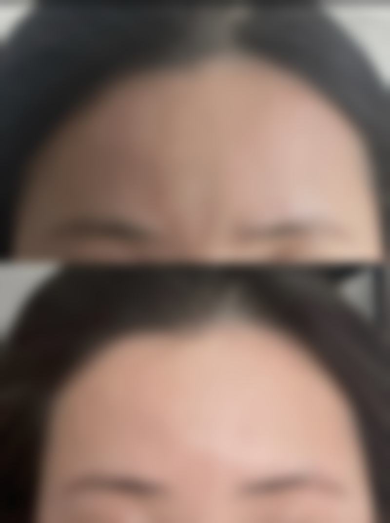 二、按摩致眼袋变大的原因