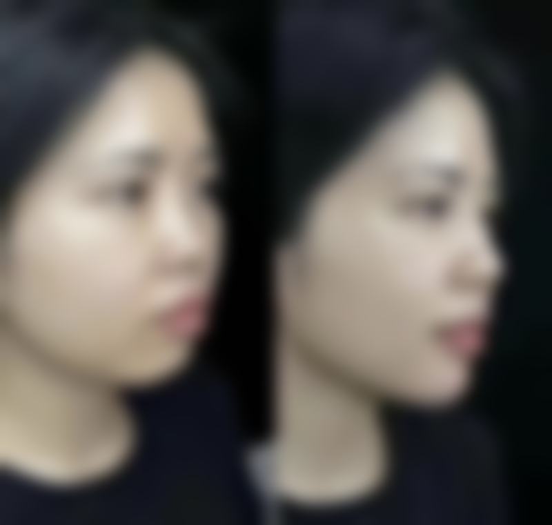 五、臀部吸脂塑形的注意事项