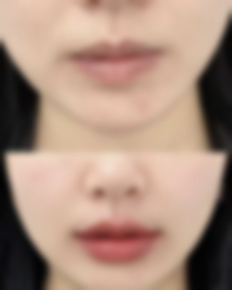 三、超体耳软骨隆鼻可以光取假体吗