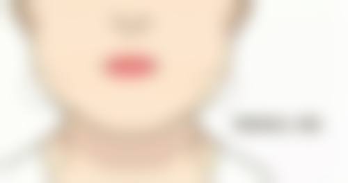 五、打瓜子脸针跟瘦脸针的成效区别