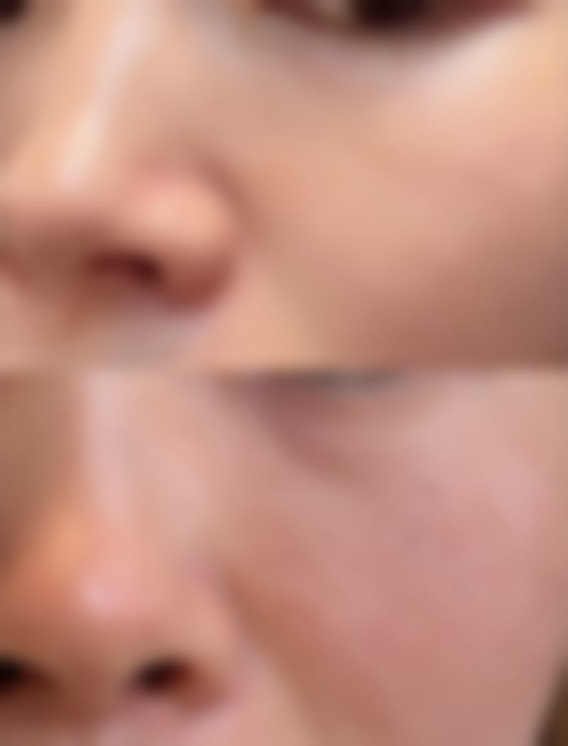 打瓜子脸针跟瘦脸针有什么区别呢？深度剖析两者差异助你选对美脸方式