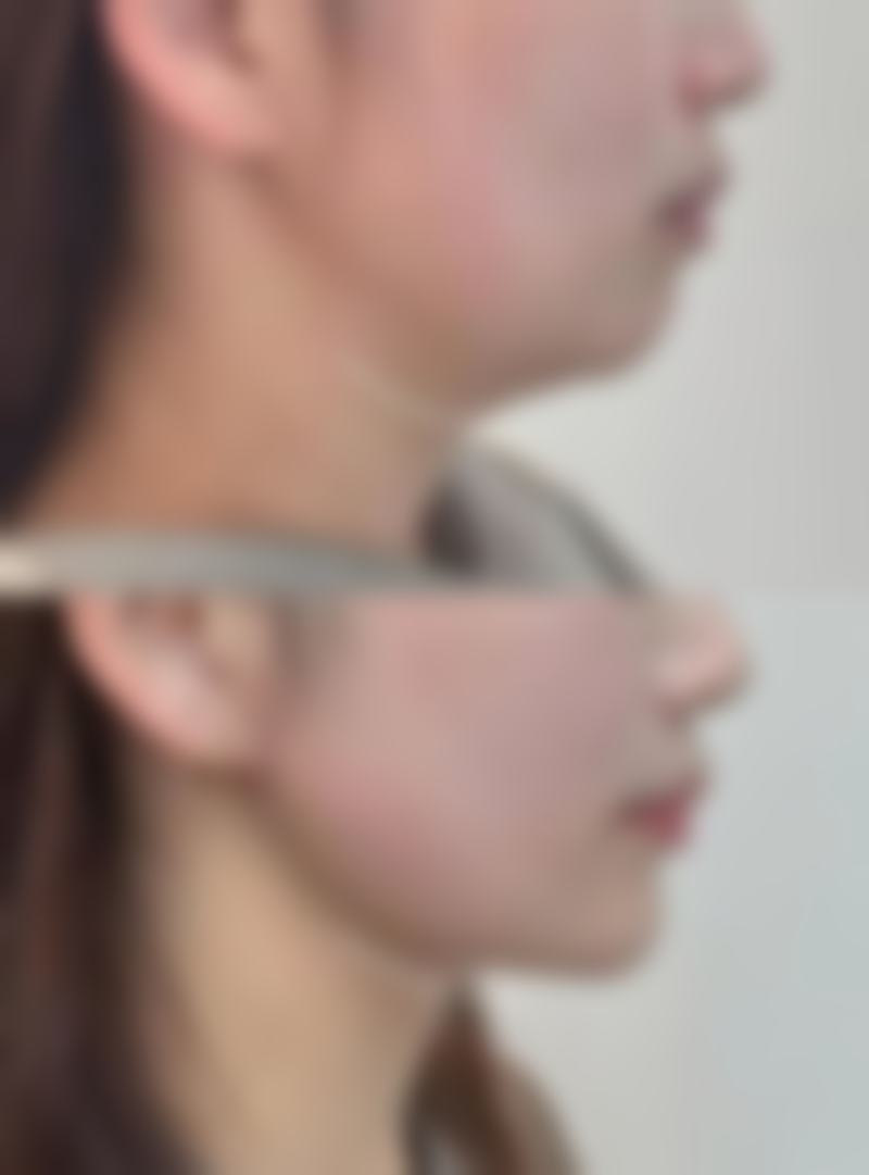 三、去除脸上疤痕的多种疗法