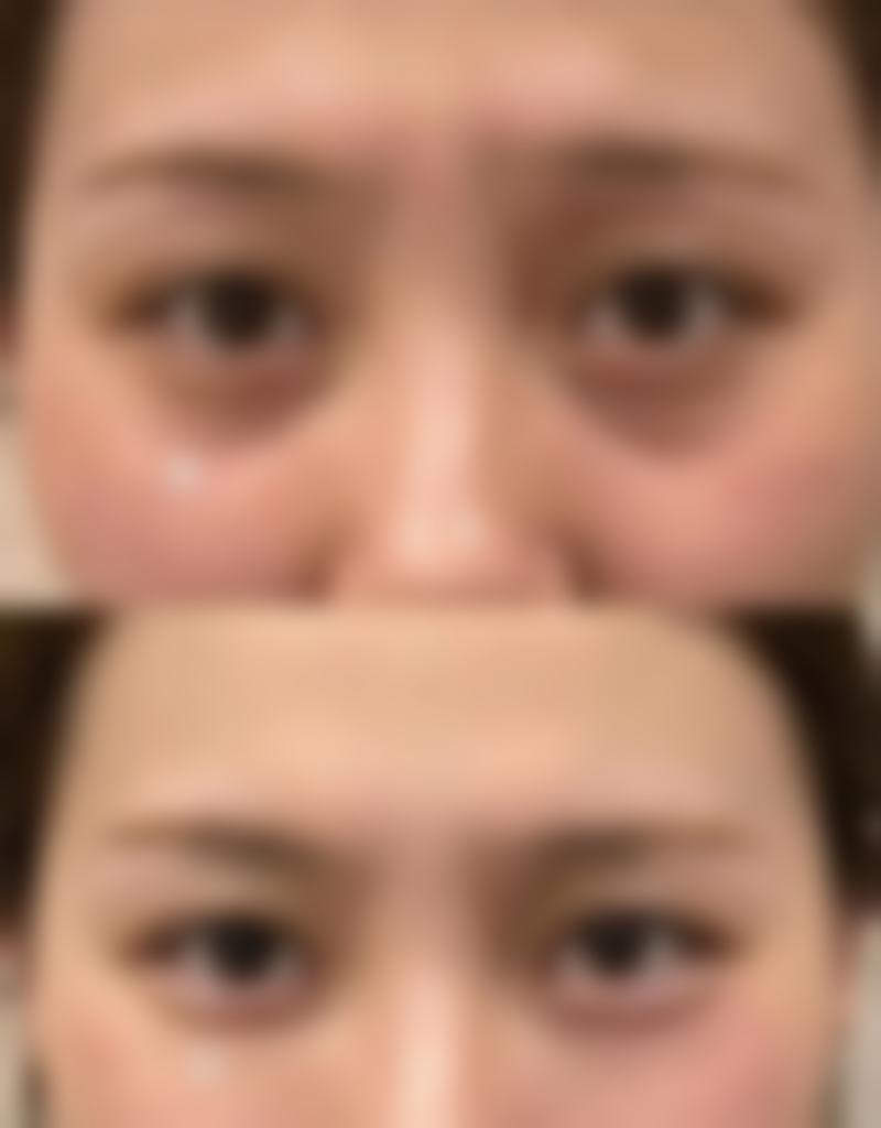 眼袋用眼贴可以去掉吗？了解眼贴去眼袋效果及相关图片展示