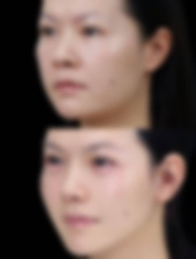 二、去除脸上疤痕的适用药物
