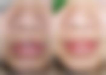 三、应对割完双眼皮老年变化的措施