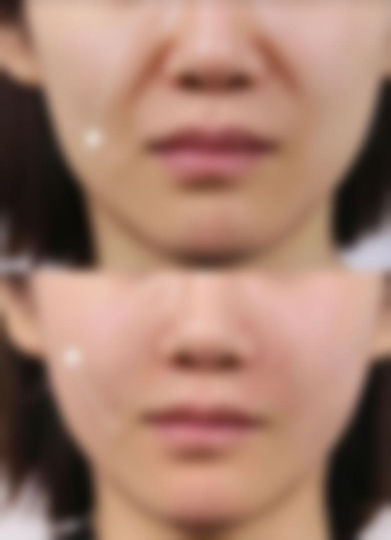 二、影响割完双眼皮老年变化的因素