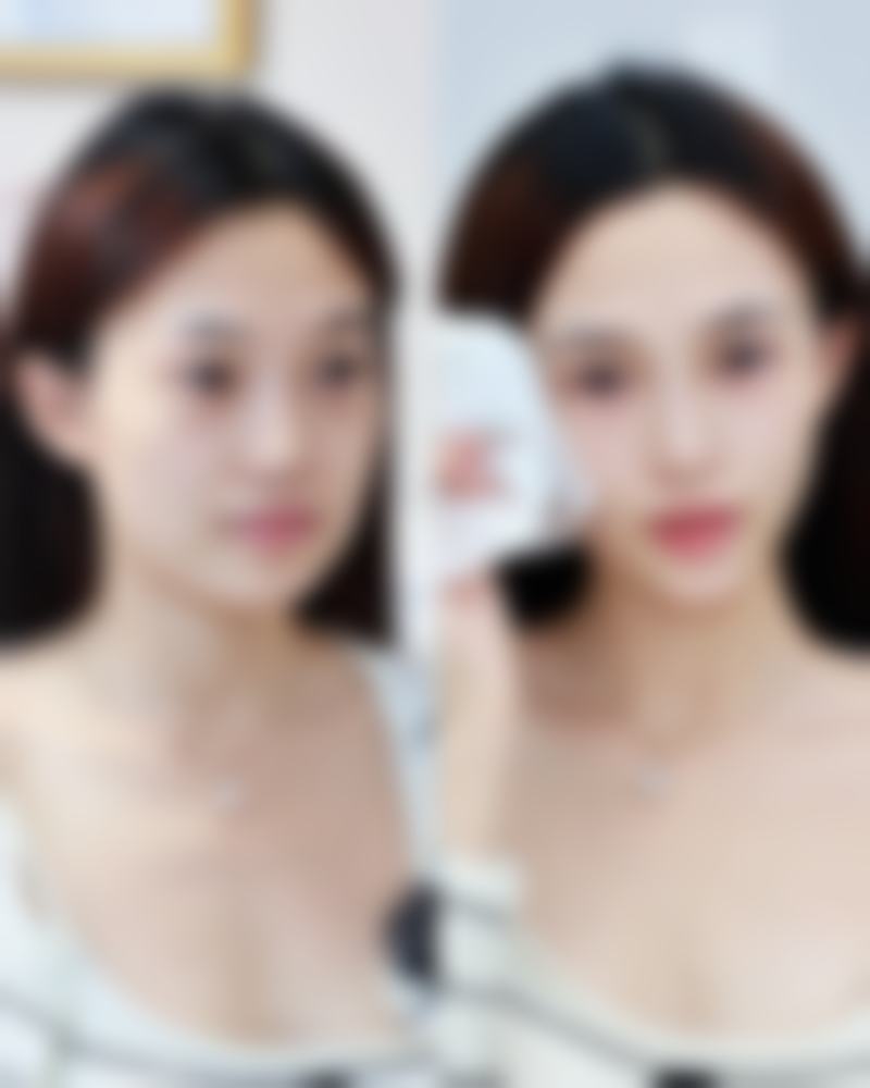 一、割完双眼皮老了可能面临的潜在变化