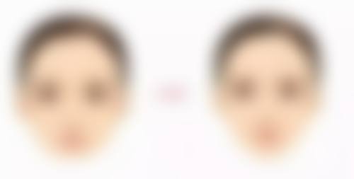 双眼皮术后多少天可以洗澡洗头？答案与个人恢复情况密切相关！ 