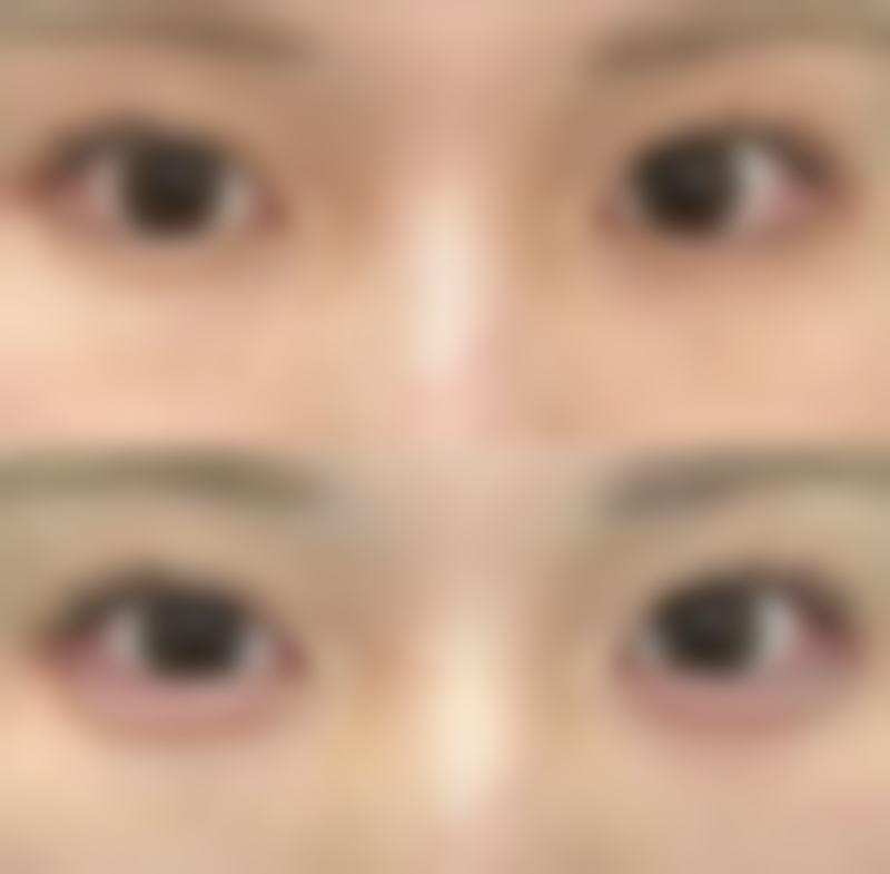 做完双眼皮拆线后眼皮有褶皱怎么办？教你应对方法告别眼部褶皱困扰