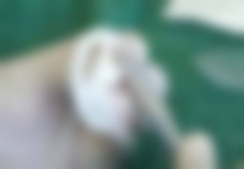 一、凹陷性疤痕的成因
