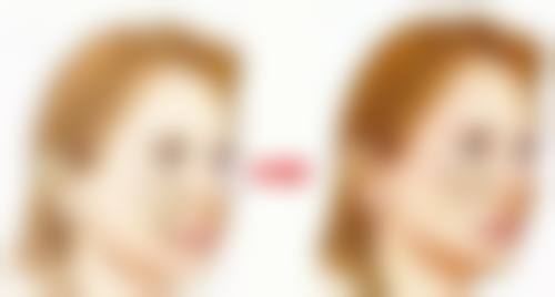 三、小腿抽脂相关情况