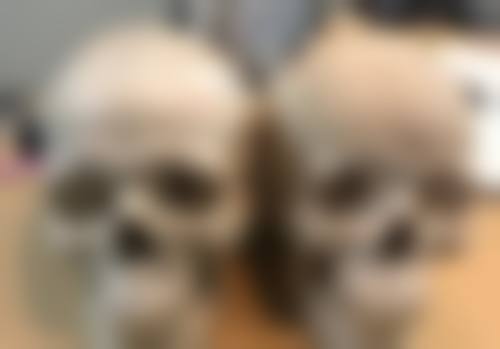 胸前长了个疤痕疙瘩怎么去除？多种有效方法助你告别烦恼恢复光滑肌肤