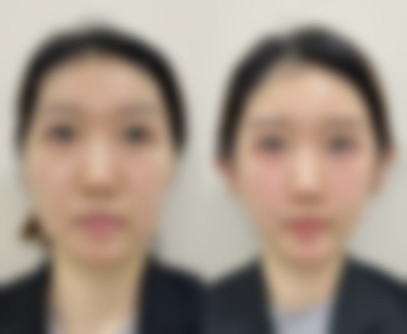 四、假体破裂或泄漏情况