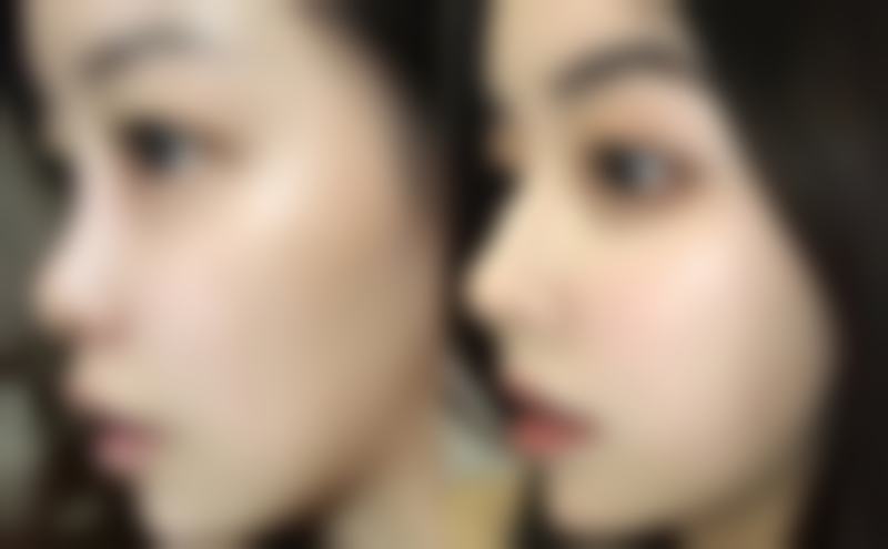 一、抽脂的常见风险和后遗症