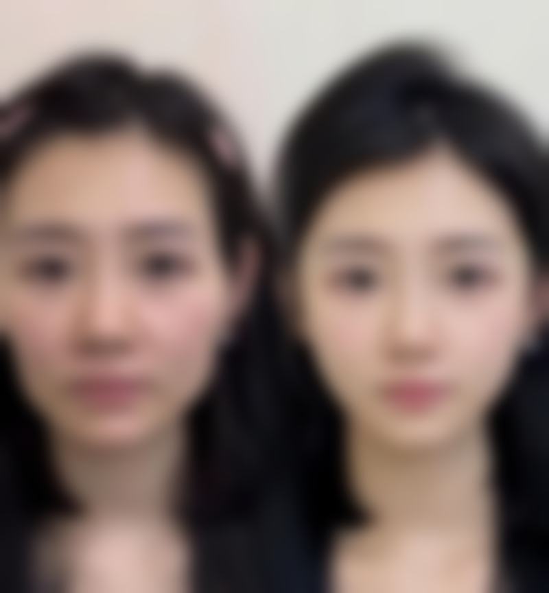 四、再次手术加宽可能面临的风险