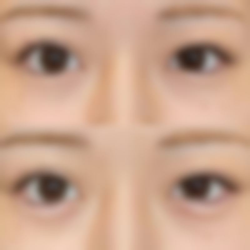 五、假体隆胸成效之提高自信心