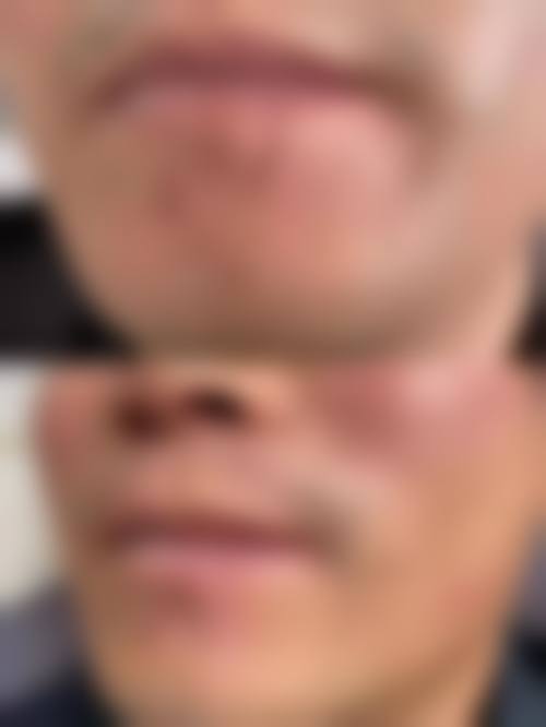 五、广州佳和医院血管瘤科价格表