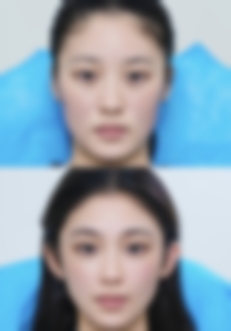 四、打瘦脸针的注意事项