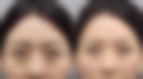 来月经为什么不能做双眼皮手术?总结一下