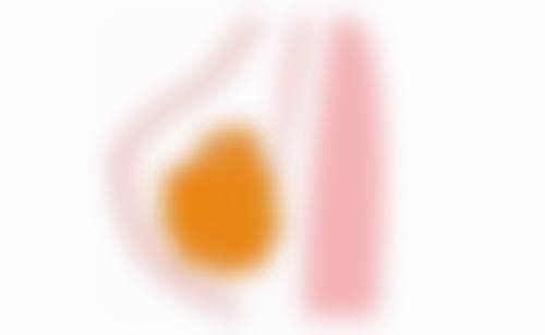 割双眼皮留下的疤痕能除掉吗？去除方法及所需费用大揭秘！ 