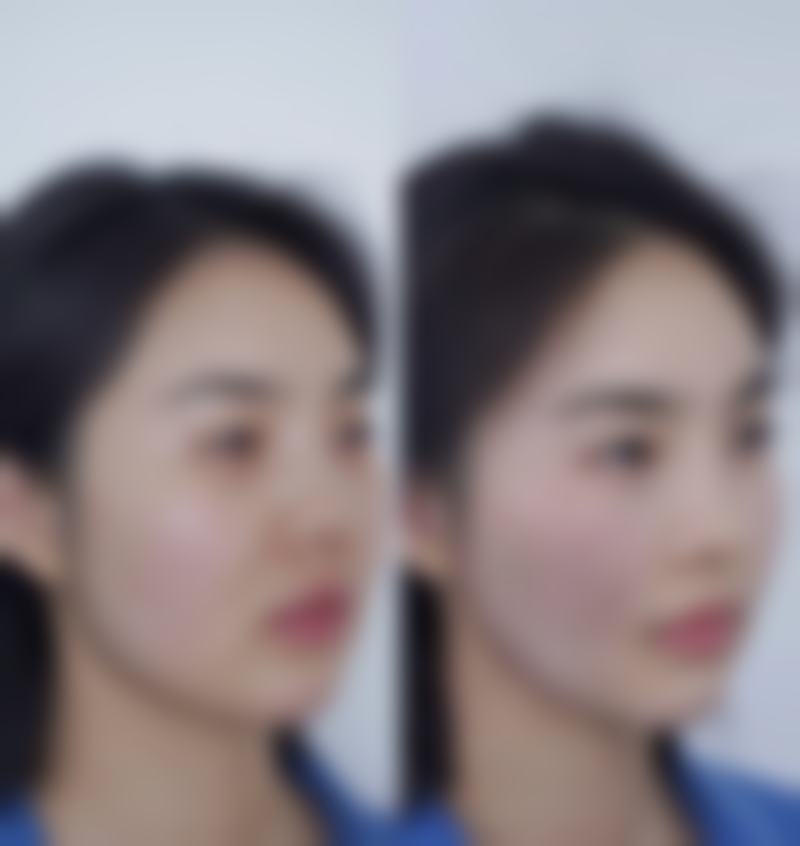 三、割双眼皮留下的疤痕去除所需费用