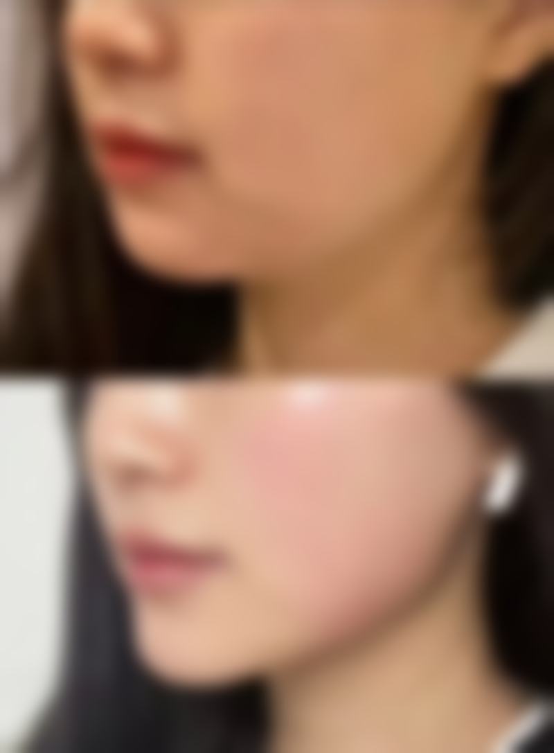 五、割双眼皮留下的疤痕能除掉吗?总结