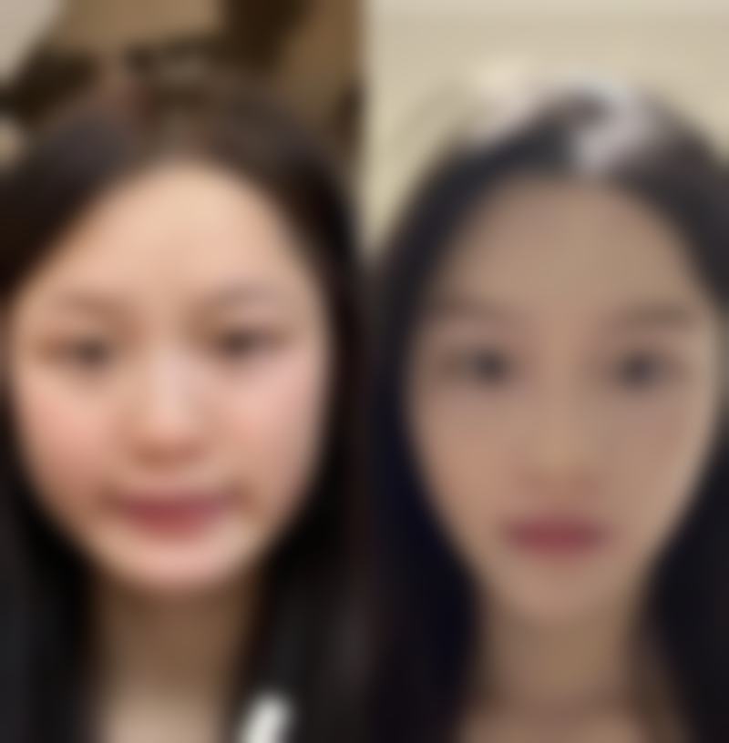 一、割双眼皮留下疤痕的影响因素