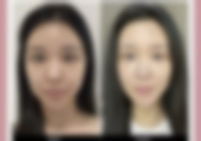 一、来月经做双眼皮手术,出血风险大大增加