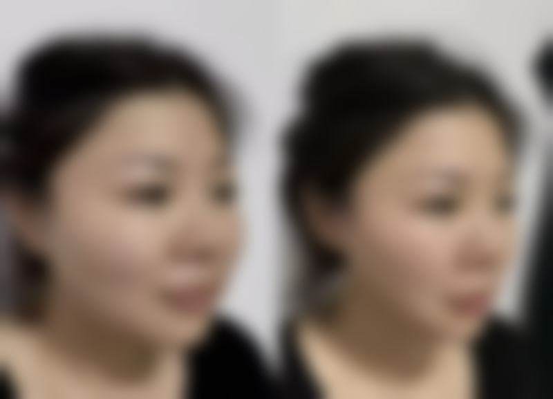 五、去眼袋用什么软膏有效之其他去眼袋方法