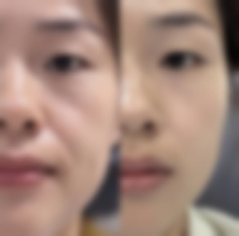 四、脸上抓伤疤痕怎样去掉之手术治疗
