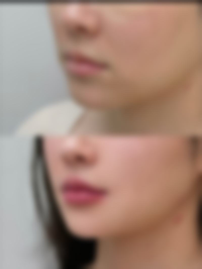 三、手术过程