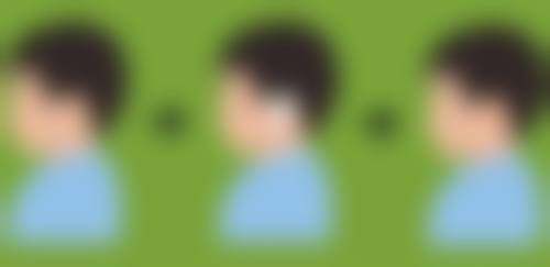 一、双眼皮手术后怎么不一样大之正常现象