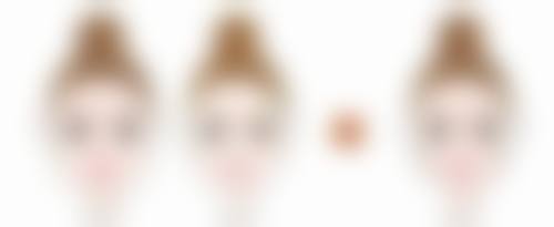 二、双眼皮手术后怎么不一样大之手术技术因素