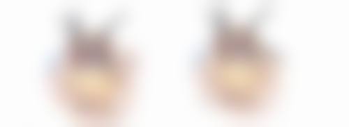 四、双眼皮手术后怎么不一样大之能否修复正常