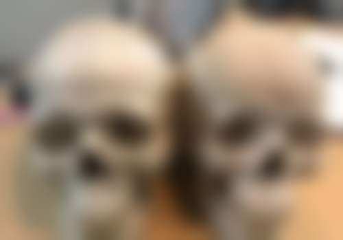 三、怎样祛眼袋有成效之术后护理和日常保养
