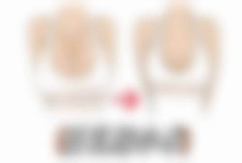 一、怎样去特别重的眼袋之手术切除法