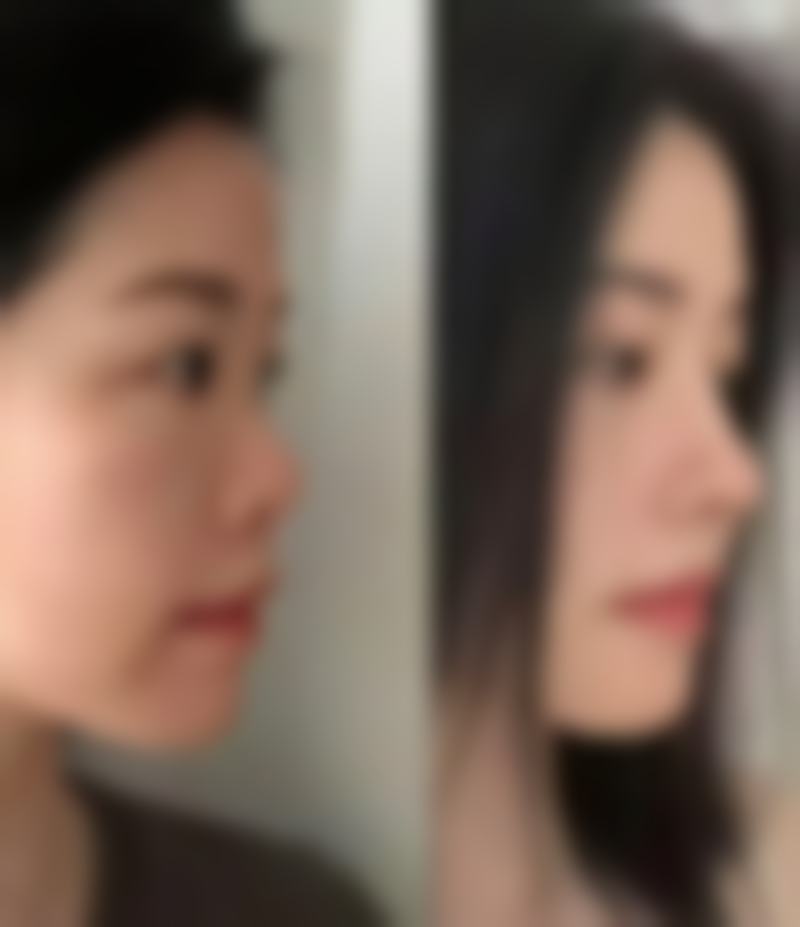 一、认识下眼袋上的脂肪粒