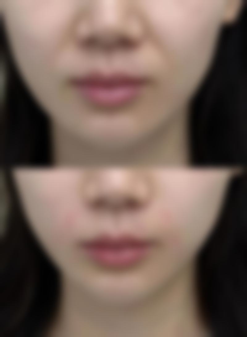四、凹进去的疤痕治疗的注意事项