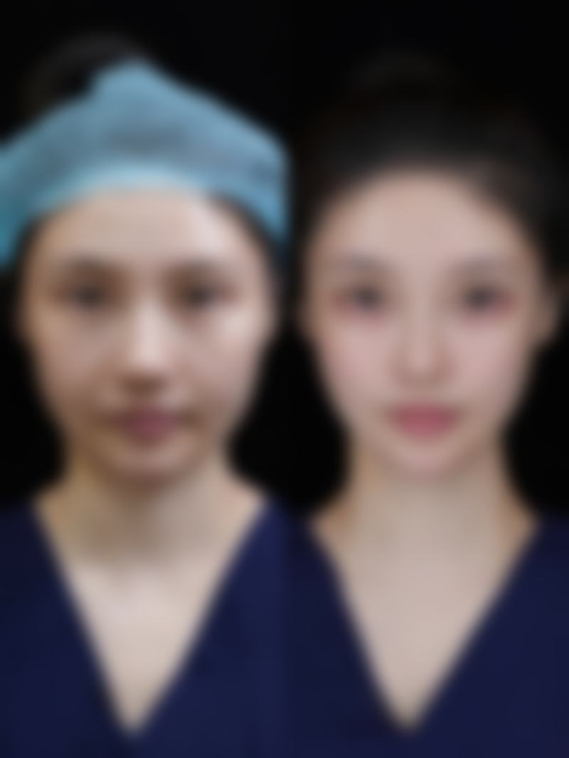 二、肋软骨隆鼻术后遗症之软骨变形