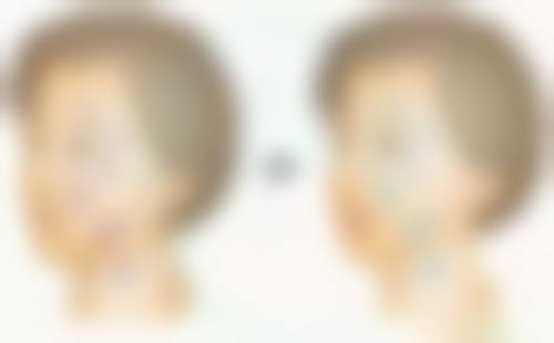 四、梦想打瘦脸针之术后注意事项