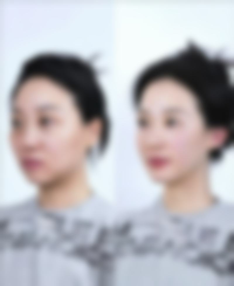二、滴眼液能去眼袋吗？