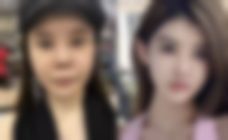 三、梦想打瘦脸针之注射过程揭秘