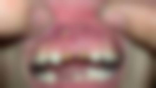 优惠活动详情:儿童早期矫正确立价格新标杆