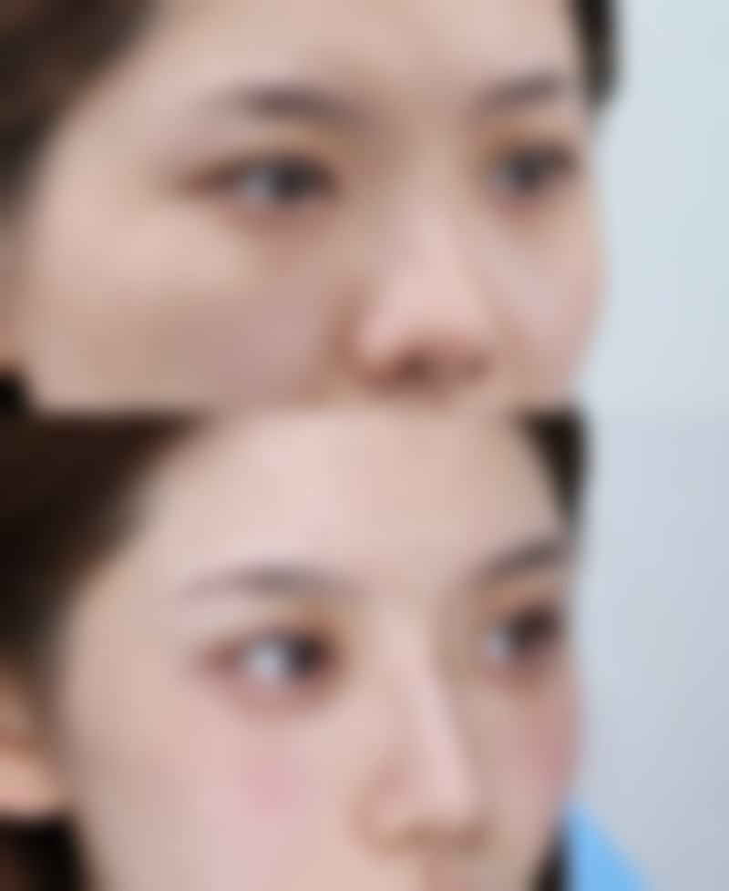 二、影响隆胸适宜年龄的身体因素