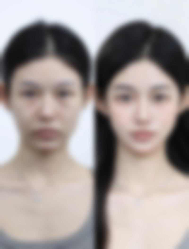 二、隆胸手术后遗症中的疼痛相关情况