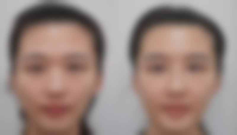 三、头发种植的术前准备