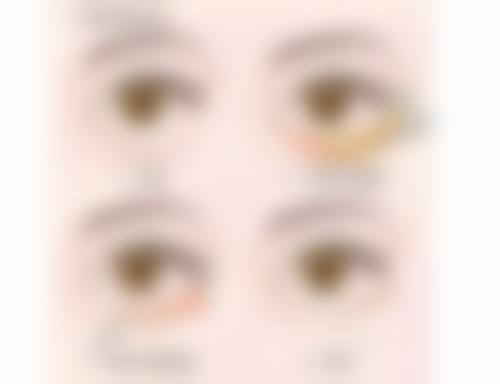 三、影响黛元堂去眼袋成效的因素
