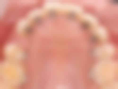 优惠活动详情——限时补贴,守护口腔健康